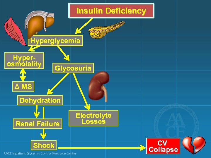 Insulin Deficiency Hyperglycemia Hyperosmolality Glycosuria Δ MS Dehydration Renal Failure Shock Electrolyte Losses CV
