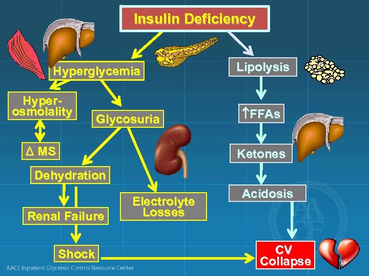 Insulin Deficiency Hyperglycemia Hyperosmolality Glycosuria Δ MS Lipolysis FFAs Ketones Dehydration Renal Failure Shock