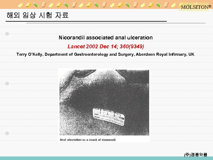 MOLSITON® 해외 임상 시험 자료 Nicorandil associated anal ulceration Lancet 2002 Dec 14; 360(9349)