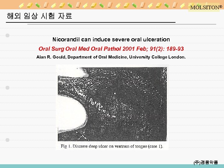 MOLSITON® 해외 임상 시험 자료 Nicorandil can induce severe oral ulceration Oral Surg Oral