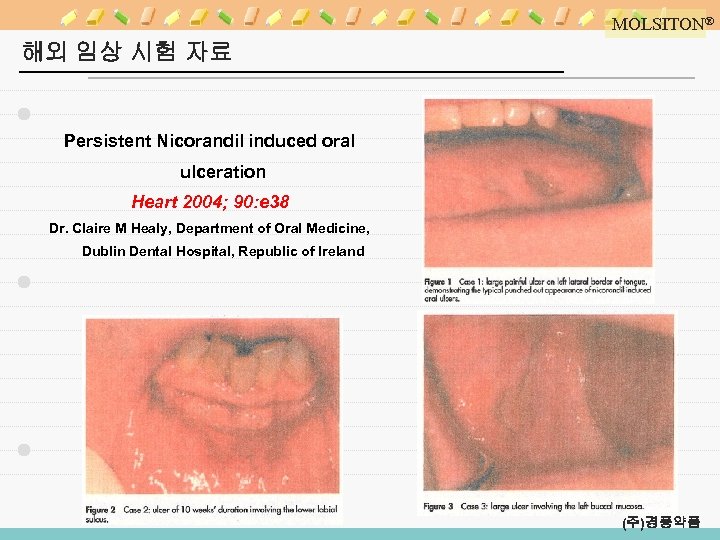 MOLSITON® 해외 임상 시험 자료 Persistent Nicorandil induced oral ulceration Heart 2004; 90: e