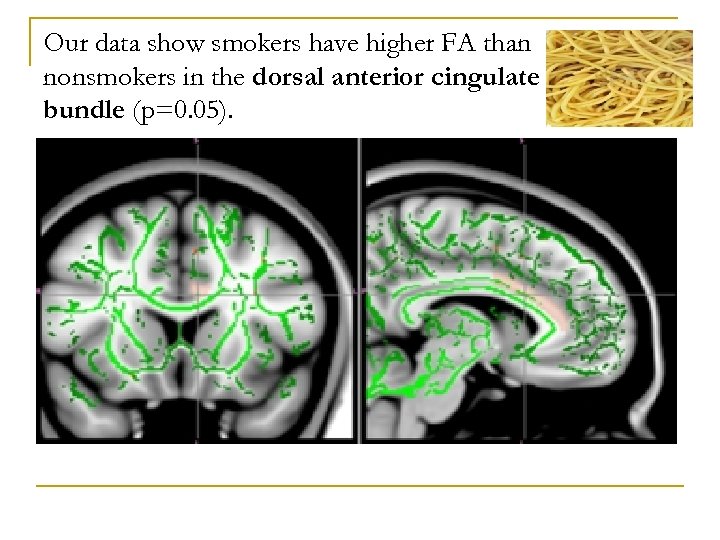 Our data show smokers have higher FA than nonsmokers in the dorsal anterior cingulate