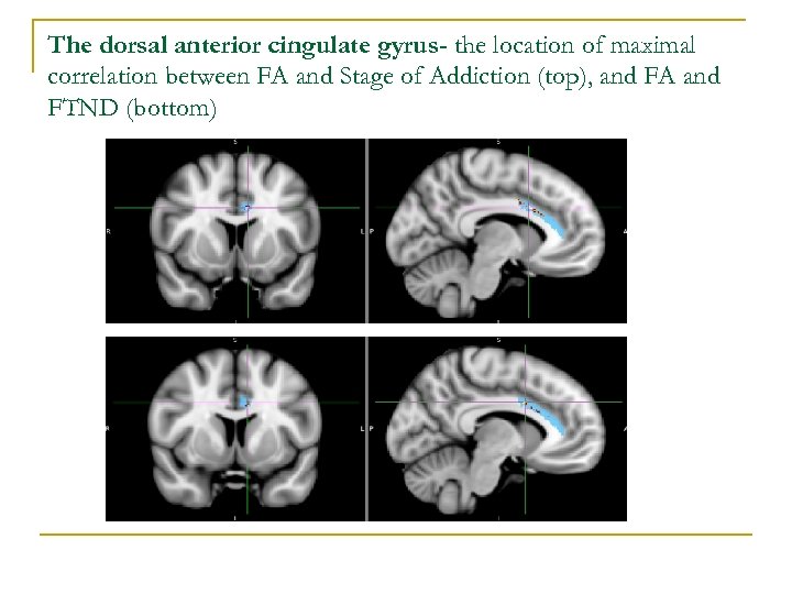 The dorsal anterior cingulate gyrus- the location of maximal correlation between FA and Stage