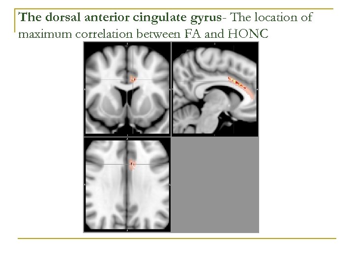 The dorsal anterior cingulate gyrus- The location of maximum correlation between FA and HONC
