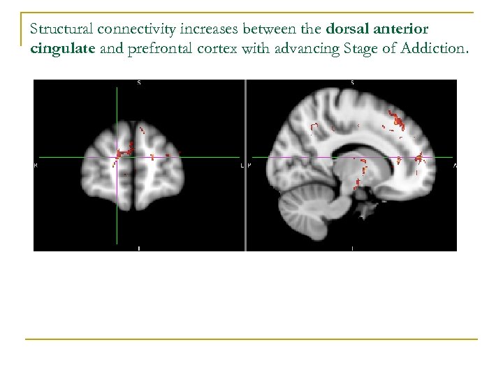 Structural connectivity increases between the dorsal anterior cingulate and prefrontal cortex with advancing Stage