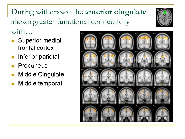 During withdrawal the anterior cingulate shows greater functional connectivity with… n n n Superior