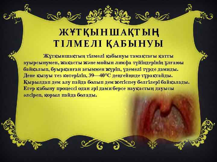 ЖҰТҚЫНШАҚТЫҢ ТІЛМЕЛІ ҚАБЫНУЫ Жұтқыншақтың тілмелі қабынуы тамақтағы қатты ауырсынумен, жақасты және мойын лимфа түйіндерінің