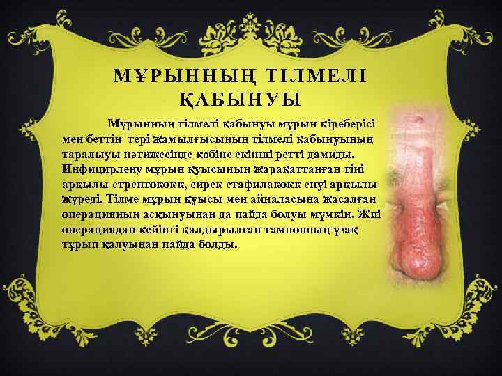 МҰРЫННЫҢ ТІЛМЕЛІ ҚАБЫНУЫ Мұрынның тілмелі қабынуы мұрын кіреберісі мен беттің тері жамылғысының тілмелі қабынуының