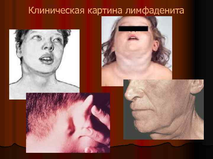 Клиническая картина лимфаденита 