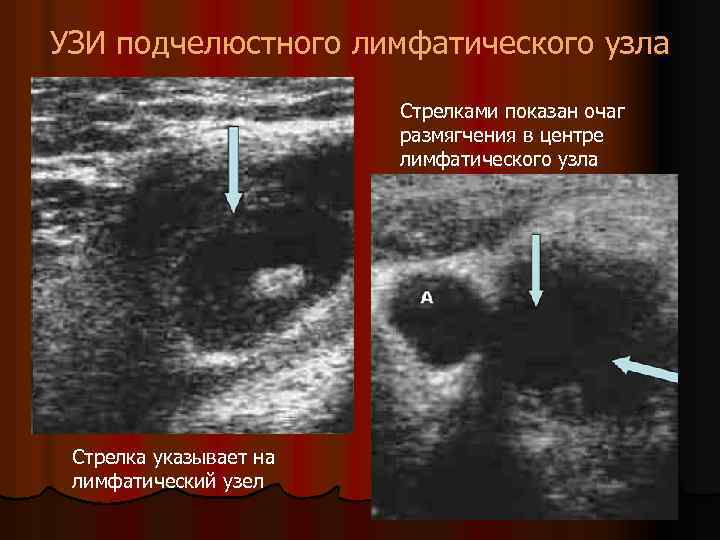 УЗИ подчелюстного лимфатического узла Стрелками показан очаг размягчения в центре лимфатического узла Стрелка указывает