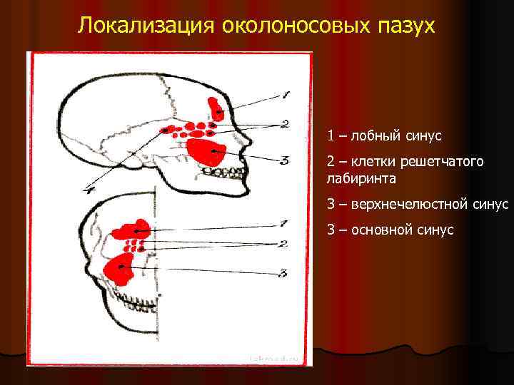 Локализация околоносовых пазух 1 – лобный синус 2 – клетки решетчатого лабиринта 3 –