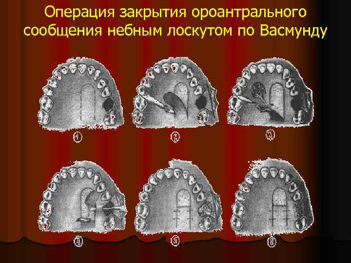 Операция закрытия ороантрального сообщения небным лоскутом по Васмунду 