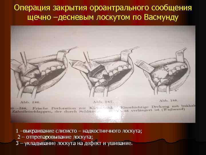 Операция закрытия ороантрального сообщения щечно –десневым лоскутом по Васмунду 1 –выкраивание слизисто – надкостничного