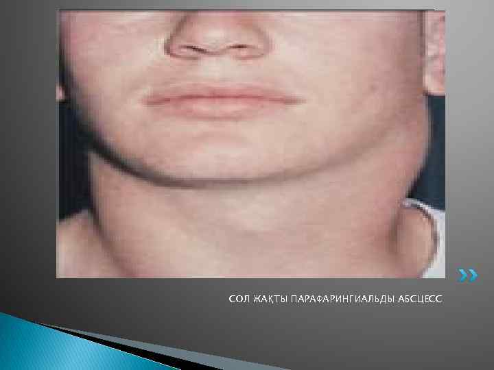СОЛ ЖАҚТЫ ПАРАФАРИНГИАЛЬДЫ АБСЦЕСС 