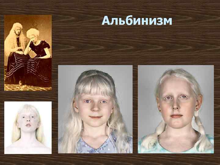 Альбинизм 