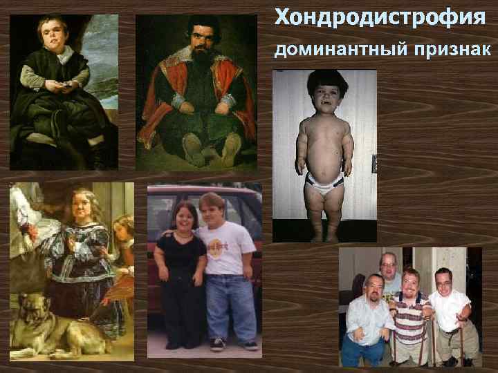 Хондродистрофия доминантный признак 