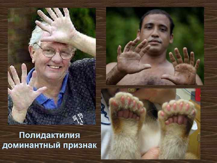 Полидактилия доминантный признак 