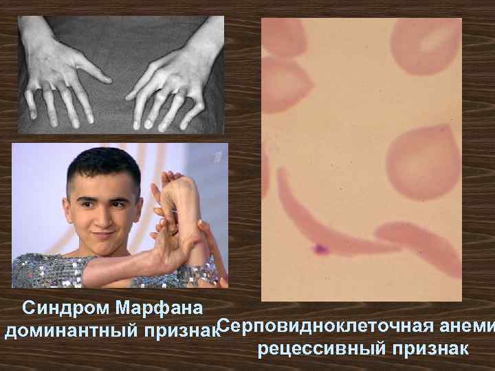 Синдром Марфана Серповидноклеточная анеми доминантный признак рецессивный признак 