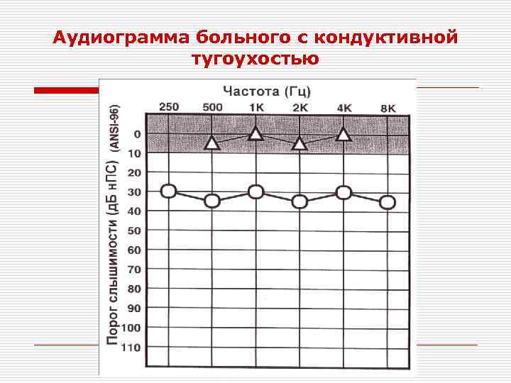 Аудиограмма больного с кондуктивной тугоухостью 