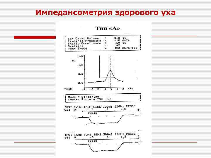 Импедансометрия здорового уха 