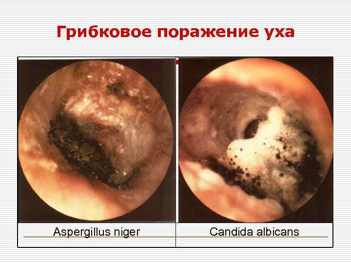 Грибковое поражение уха Aspergillus niger Candida albicans 