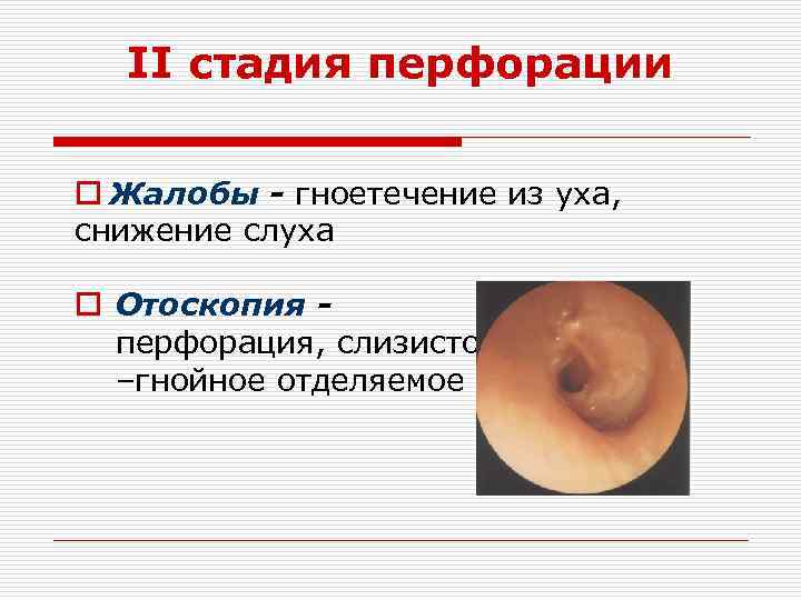 II стадия перфорации o Жалобы - гноетечение из уха, снижение слуха o Отоскопия перфорация,
