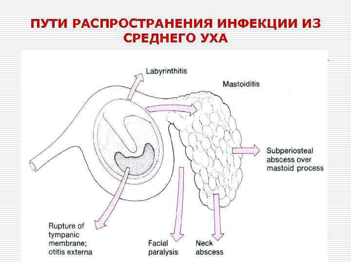 ПУТИ РАСПРОСТРАНЕНИЯ ИНФЕКЦИИ ИЗ СРЕДНЕГО УХА 