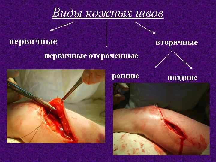 Виды кожных швов первичные вторичные первичные отсроченные ранние поздние 
