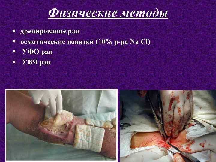 Физические методы § § дренирование ран осмотические повязки (10% р-ра Na Cl) УФО ран
