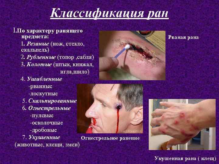 Классификация ран I. По характеру ранящего предмета: 1. Резаные (нож, стекло, скальпель) 2. Рубленные