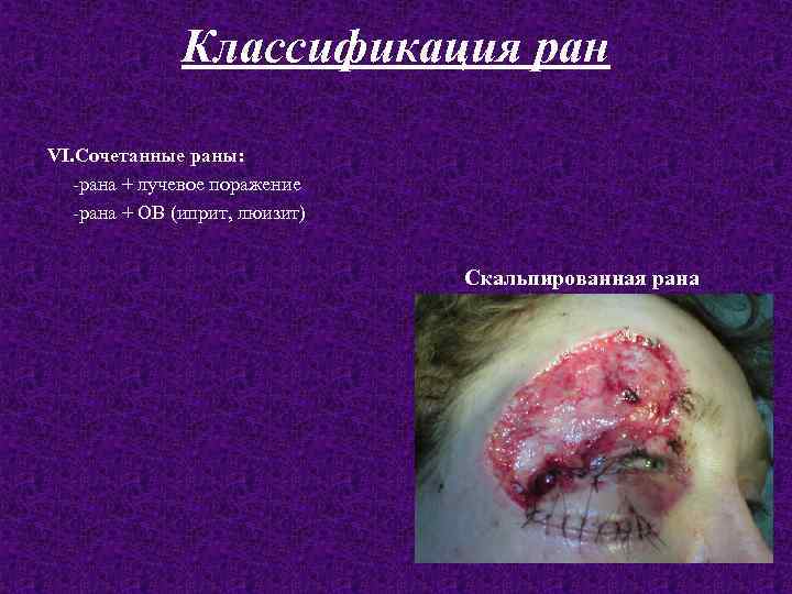 Классификация ран VI. Сочетанные раны: -рана + лучевое поражение -рана + ОВ (иприт, люизит)