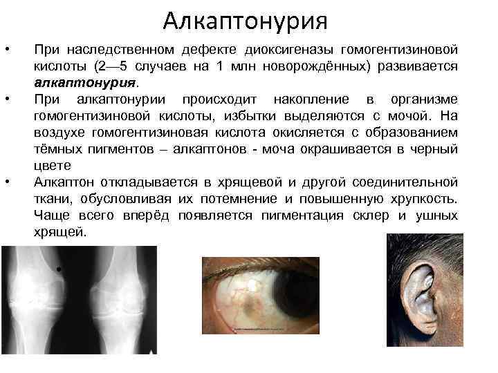 Алкаптонурия клиническая картина