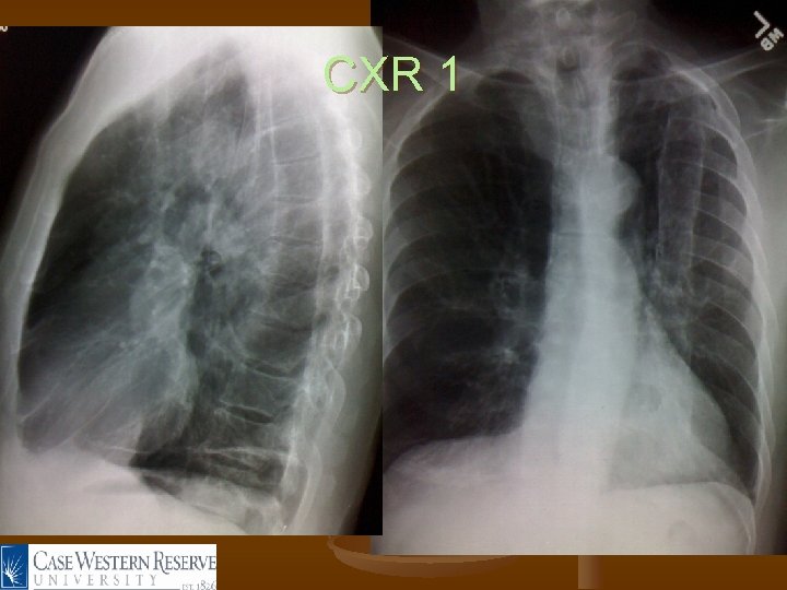 CXR 1 