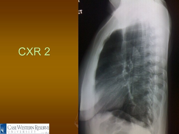 CXR 2 