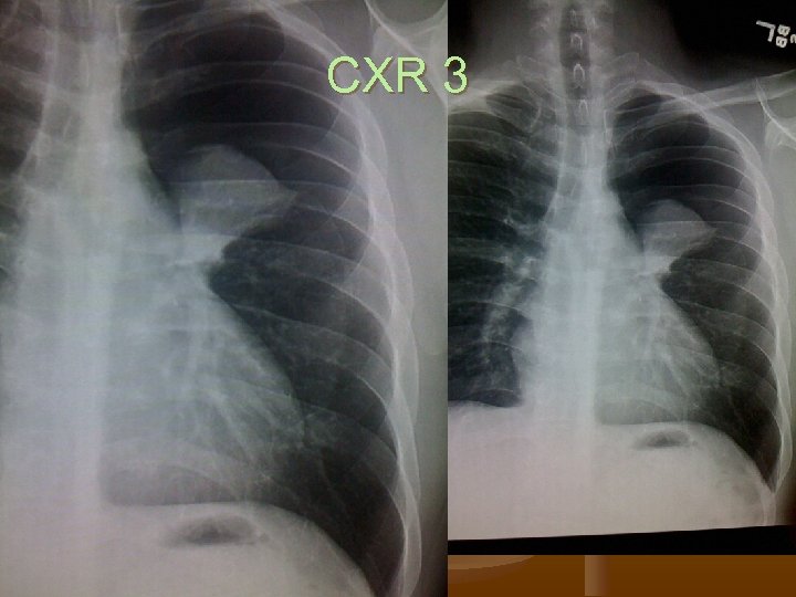 CXR 3 