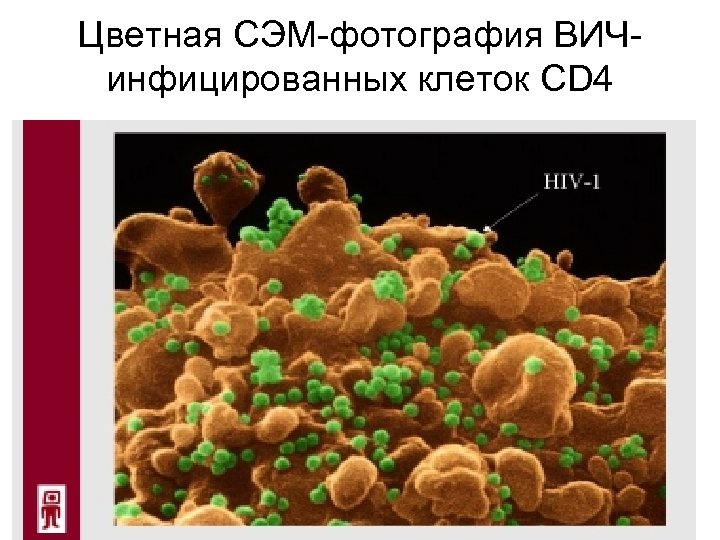 Цветная СЭМ-фотография ВИЧинфицированных клеток CD 4 