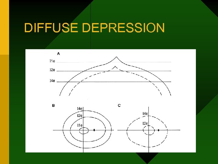 DIFFUSE DEPRESSION 