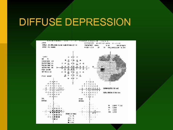 DIFFUSE DEPRESSION 