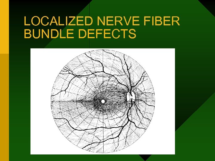 LOCALIZED NERVE FIBER BUNDLE DEFECTS 