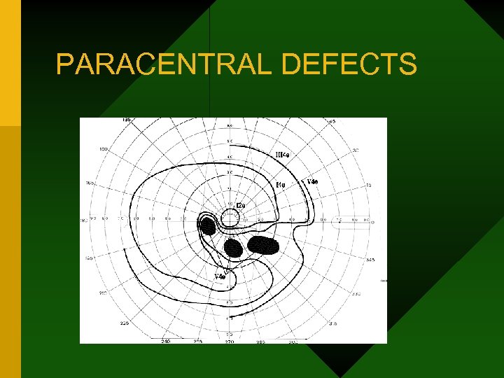 PARACENTRAL DEFECTS 