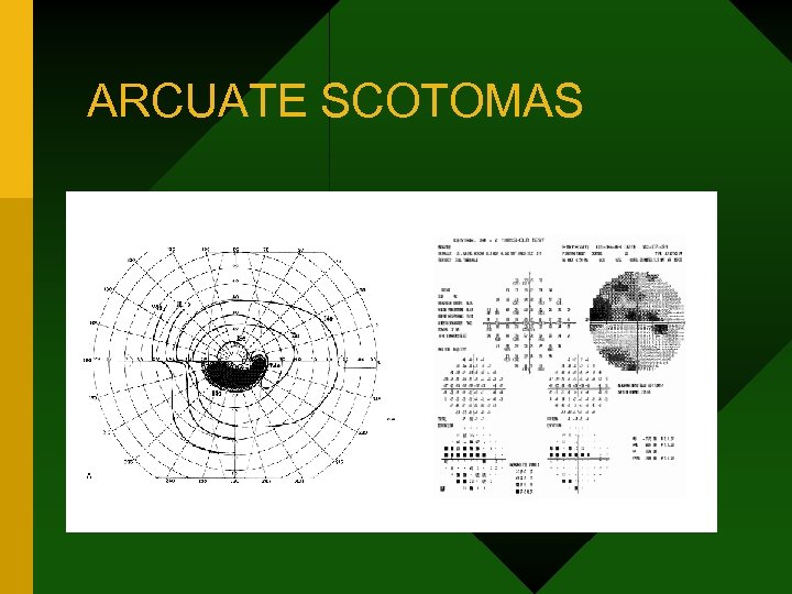 ARCUATE SCOTOMAS 