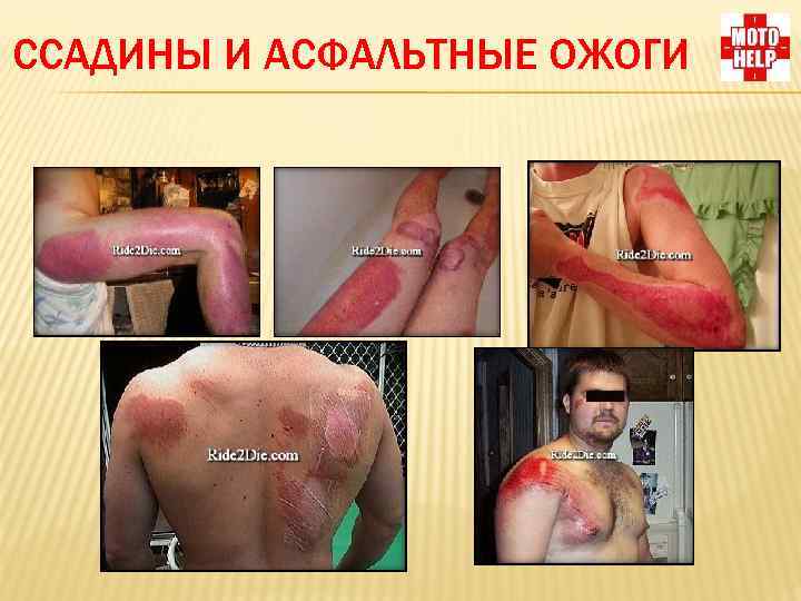 ССАДИНЫ И АСФАЛЬТНЫЕ ОЖОГИ 
