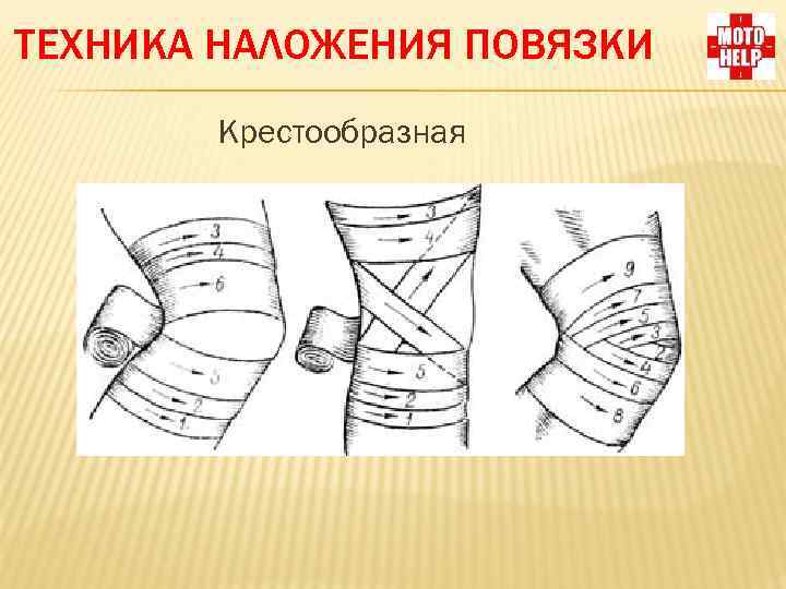 ТЕХНИКА НАЛОЖЕНИЯ ПОВЯЗКИ Крестообразная 