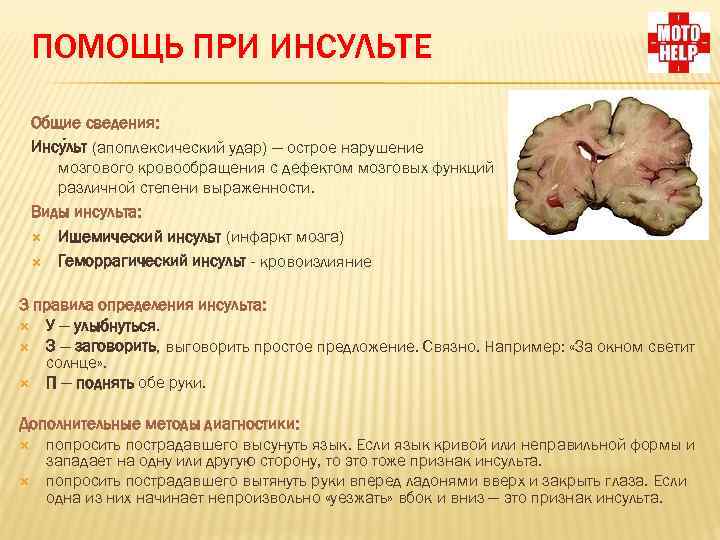 ПОМОЩЬ ПРИ ИНСУЛЬТЕ Общие сведения: Инсу льт (апоплексический удар) — острое нарушение мозгового кровообращения