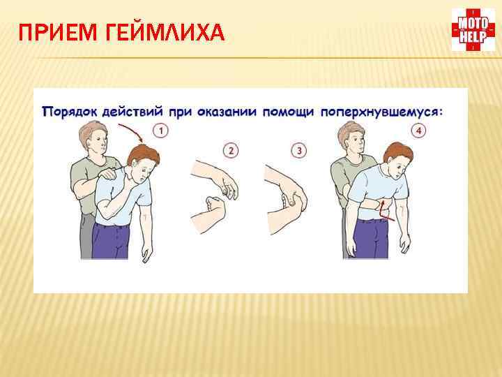 ПРИЕМ ГЕЙМЛИХА 