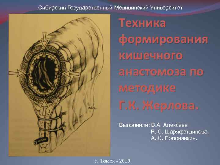 Сибирский Государственный Медицинский Университет Техника формирования кишечного анастомоза по методике Г. К. Жерлова. Выполнили: