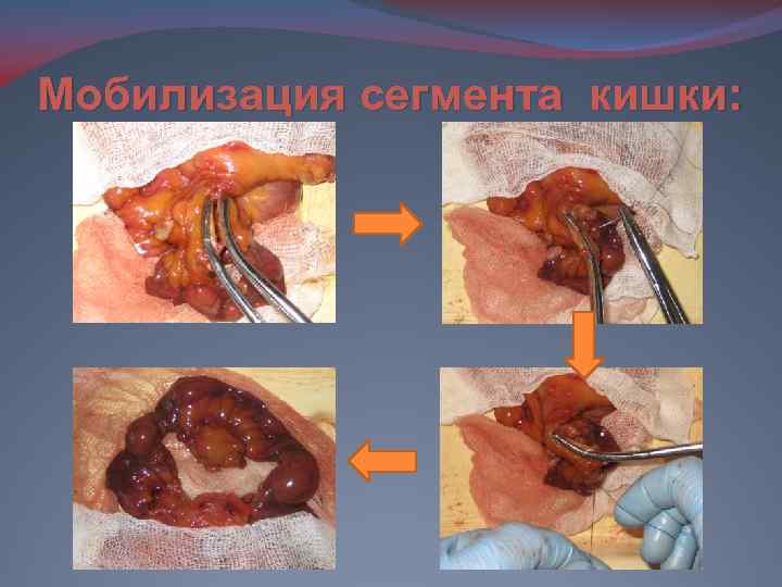 Мобилизация сегмента кишки: 