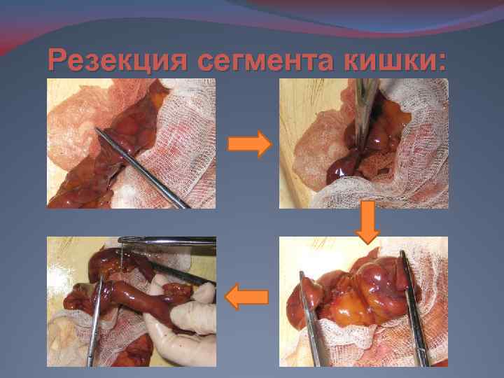 Резекция сегмента кишки: 