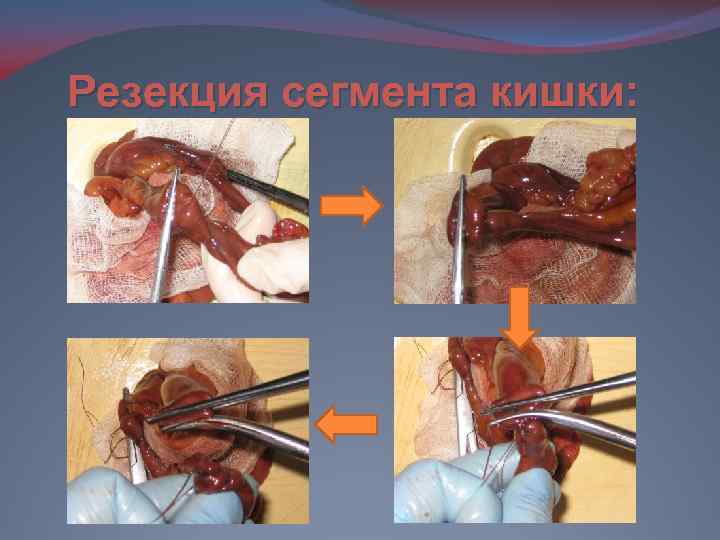 Резекция сегмента кишки: 