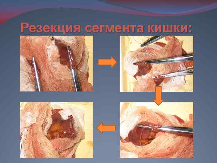 Резекция сегмента кишки: 